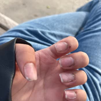 Eila Hamid Beauty Protez İşleminde Ellerimi Kanattılar, İş Bilmiyorlar!