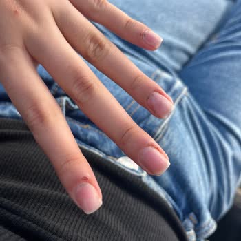 Eila Hamid Beauty Protez İşleminde Ellerimi Kanattılar, İş Bilmiyorlar!