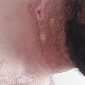 Aris Güneşli Vip Güzellik Merkezi Kabusu 3. Derece Yanık