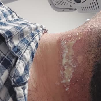 Aris Güneşli Vip Güzellik Merkezi Kabusu 3. Derece Yanık