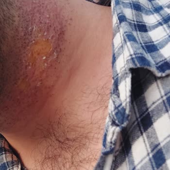 Aris Güneşli Vip Güzellik Merkezi Kabusu 3. Derece Yanık