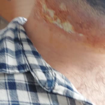 Aris Güneşli Vip Güzellik Merkezi Kabusu 3. Derece Yanık