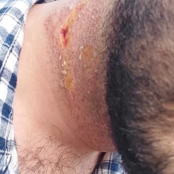 Aris Güneşli Vip Güzellik Merkezi Kabusu 3. Derece Yanık