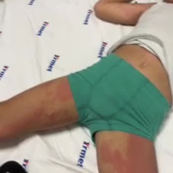 İrmet Hospital 'de Yanlış İlaç Verildi