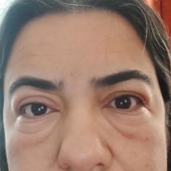 Bioderma Leke Karşıtı Güneş Kremi Alerji Yaptı