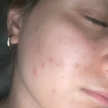 Watsons'tan Aldığım Nemlendirici Ve C Vitamini Yüzümü Mahvetti