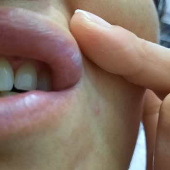 Sensodyne Diş Macunu Dudaklarımı Yaktı