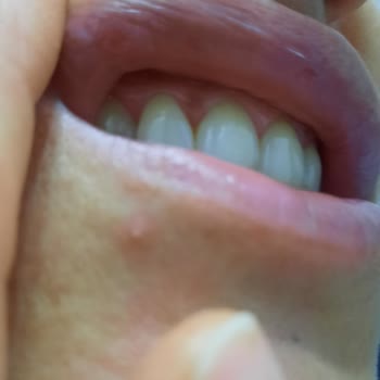 Sensodyne Diş Macunu Dudaklarımı Yaktı
