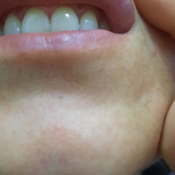 Sensodyne Diş Macunu Dudaklarımı Yaktı