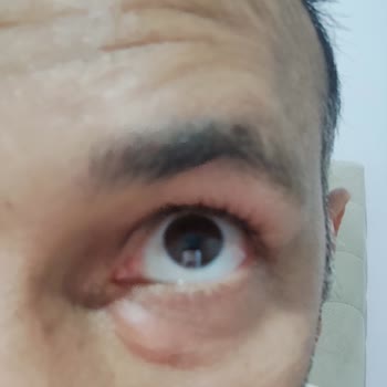 Mostar Clinic Gözaltı Işık Dolgusu Mağduriyeti