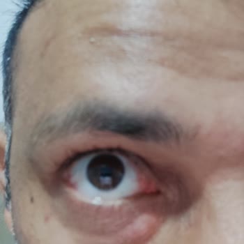 Mostar Clinic Gözaltı Işık Dolgusu Mağduriyeti