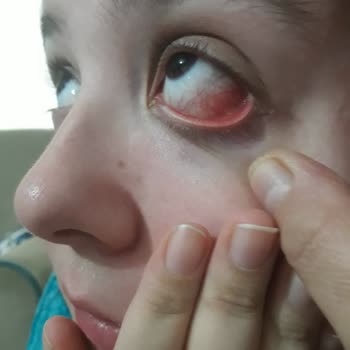 Head Shoulders Saç Şampuanı Saç Derimde Yer Yer Kanamalara Sebep Oldu