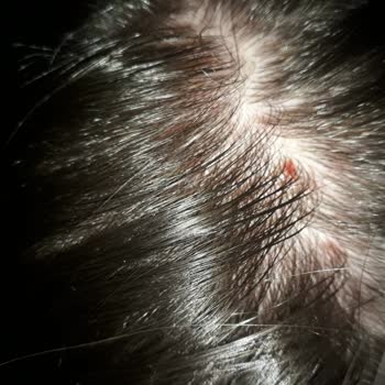 Head Shoulders Saç Şampuanı Saç Derimde Yer Yer Kanamalara Sebep Oldu