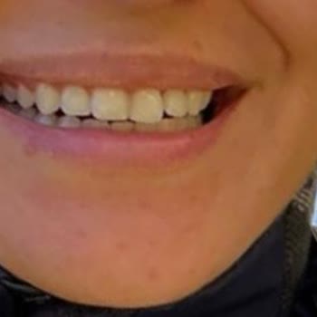 Orthero Ağız Yapısını Mahvediyor