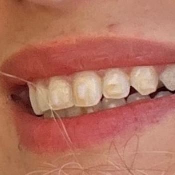 Orthero Ağız Yapısını Mahvediyor