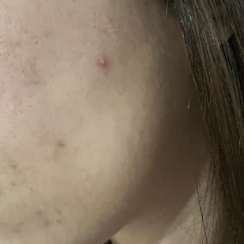 Yves Rocher Yüz Yıkama Jeli Sivilce Yaptı