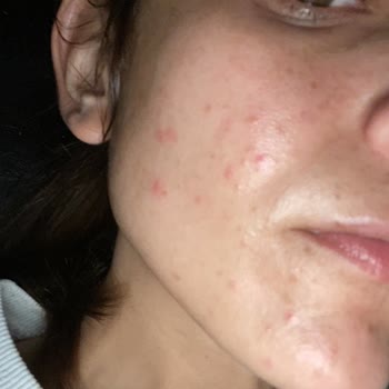 Nivea Yüz Yıkama Köpüğü Sivilcelenme Yaptı