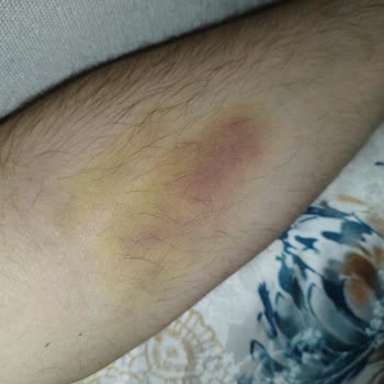 VM Medical Park Hastanesi Park Hemşiresi Damarımı Patlattı