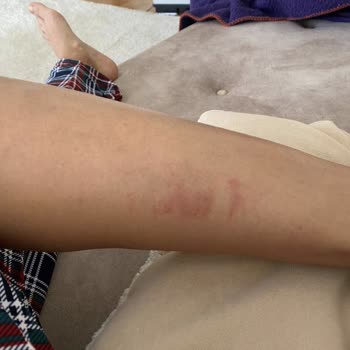 Aris Çukurambar Kaş Cihazı Ve Lazer Yanığı