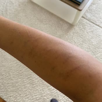 Aris Çukurambar Kaş Cihazı Ve Lazer Yanığı