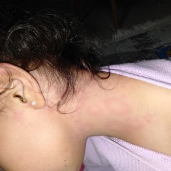 Atabay İlaç Firması 70 Ml Şurup Reaksiyon Sorunu