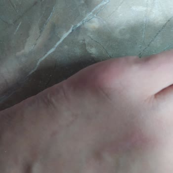 Adidas Ayakkabı Üretim Hatası Kızımın Ayağını Yara Etti