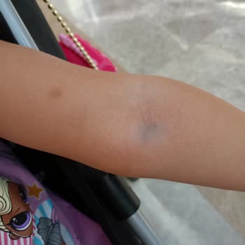 Medicana Hospitals Beylikdüzü Çocuk Hemşireleri Kan Alamıyor!