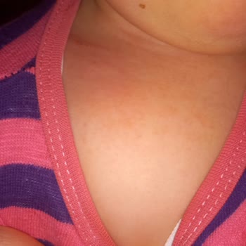 Dalin Şampuan Bebeğime Alerji Yaptı