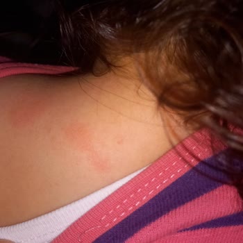 Dalin Şampuan Bebeğime Alerji Yaptı