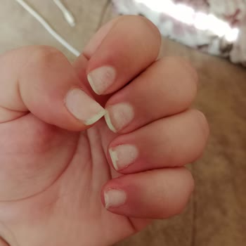 Best My Beauty Center Yanlış İşlem Yapılmış Protez Tırnak