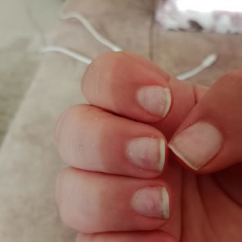 Best My Beauty Center Yanlış İşlem Yapılmış Protez Tırnak