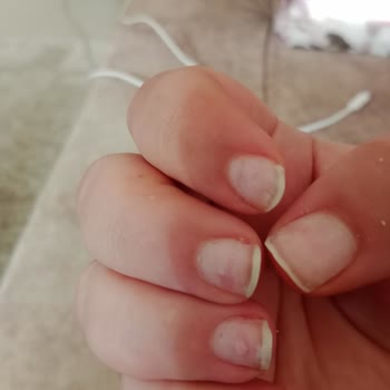 Best My Beauty Center Yanlış İşlem Yapılmış Protez Tırnak