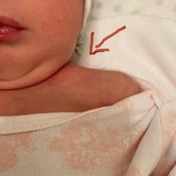 Lokman Hekim Hastaneleri Doğumda Bebeğin Köprücük Kemiğini Kırmışlar Ve Bunu Bize Bildirmediler