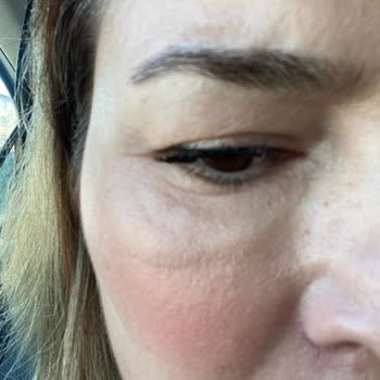 Linemed Aesthetic Linemed Ataşehir Gözaltı Şişliği