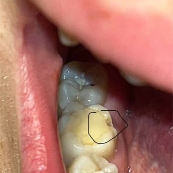 Çitello Kuruyemişleri Ürünlerinin İçerisinden Çıkan Taş, Dişimi Kırdı.