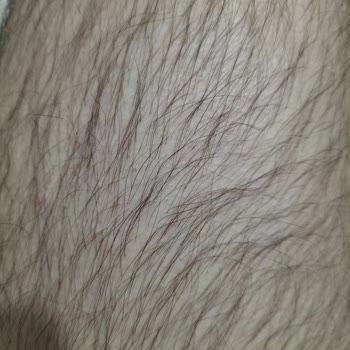 Nez Demir Kayseri Lazer Epilasyon 8 Seans Sonunda Hiçbir Etki Görmedim