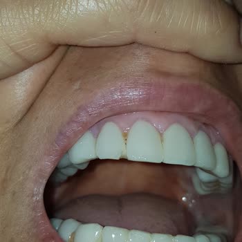 Estetik International Zirkonyum Kaplama Dişler Dökülüyor.