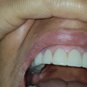 Estetik International Zirkonyum Kaplama Dişler Dökülüyor.