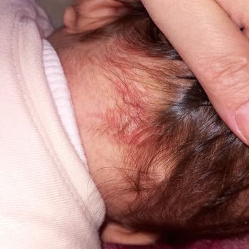 Mustela Yenidoğan Şampuan Alerji Yaptı