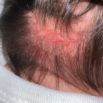 Mustela Yenidoğan Şampuan Alerji Yaptı