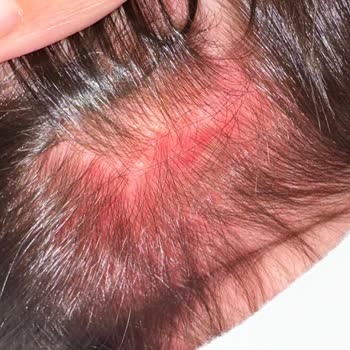 Mustela Yenidoğan Şampuan Alerji Yaptı