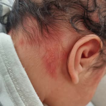 Mustela Yenidoğan Şampuan Alerji Yaptı