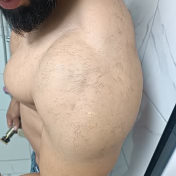 Suit Güzellik Merkezleri Lazer Sorunu