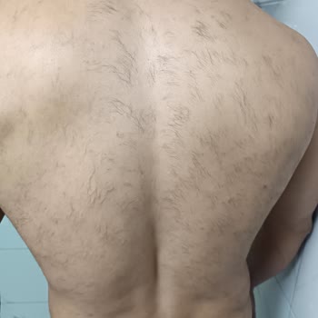 Suit Güzellik Merkezleri Lazer Sorunu