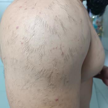 Suit Güzellik Merkezleri Lazer Sorunu