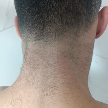 Suit Güzellik Merkezleri Lazer Sorunu