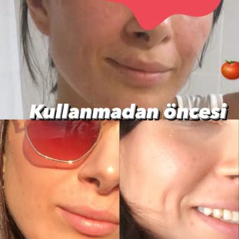 SHE Vec Ürünleri Sivilce Yaptı