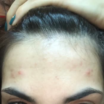 SHE Vec Ürünleri Sivilce Yaptı