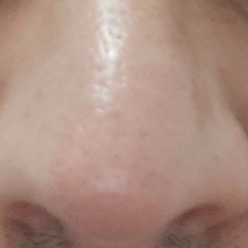 Neutrogena Markalı Yüz Temizleme Jeli (Yüzümde Sivilceler Oluşturdu)