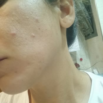 Maruderm Ürünleri Yüzümü Mahvetti